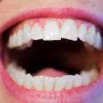 teeth-1652937_960_720[1]
